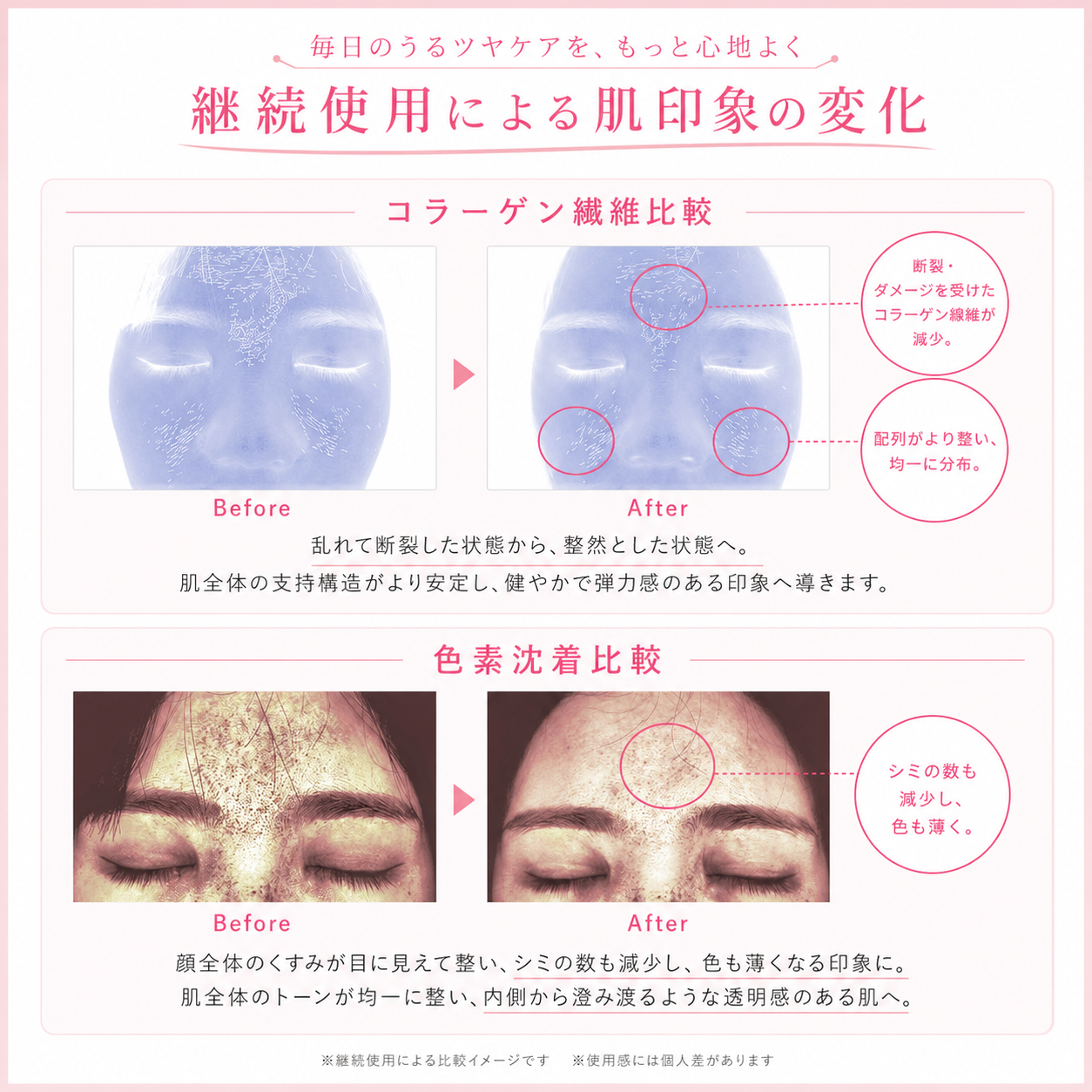 アンバサダー山本美月|ANLAN Rose Lumi LED美顔器 ピンクの光で全方位ケア 5分時短美容 EMSリフトアップ 光エステ