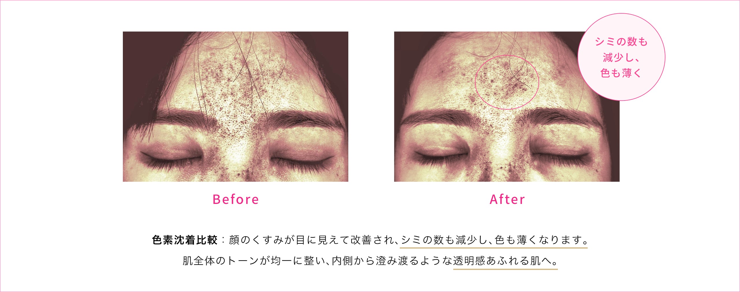 色素沈着比較 Before After